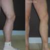 Nuevo tratamiento para eliminar varices con láser permite salir andando tras la intervención